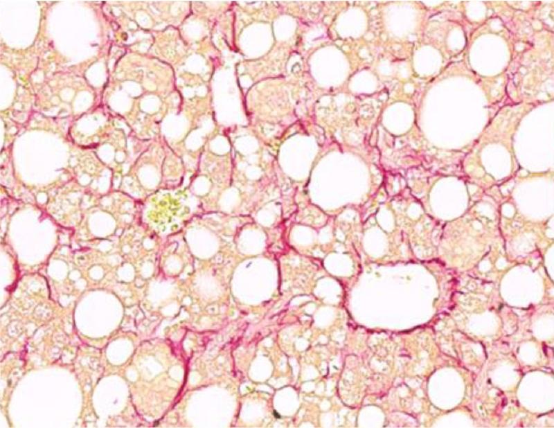 Lebergewebe mit Fibrose und rot markierten Kollagenfasern