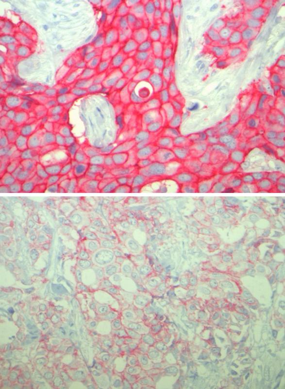 Der Tumor im Bild oben weist sehr große Mengen des HER2-Proteins auf. Die Ergebnisse der Marburger Arbeitsgruppe zeigen, dass auch eine geringere Menge von HER2 – wie auf dem Bild unten – für das Ansprechen auf Therapien von Bedeutung ist.