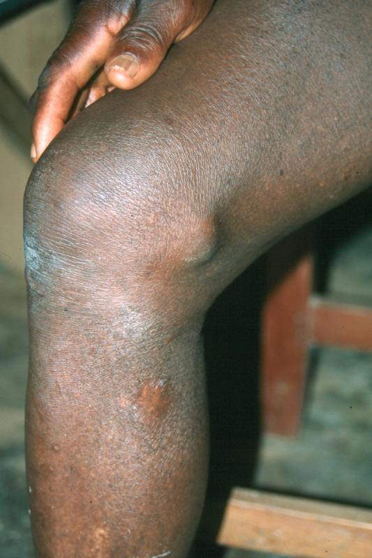 Bei den Knoten seitlich am Knie handelt es sich um Onchozerkome. Darin tragen die Weibchen Wurmlarven (Mikrofilarien) aus.