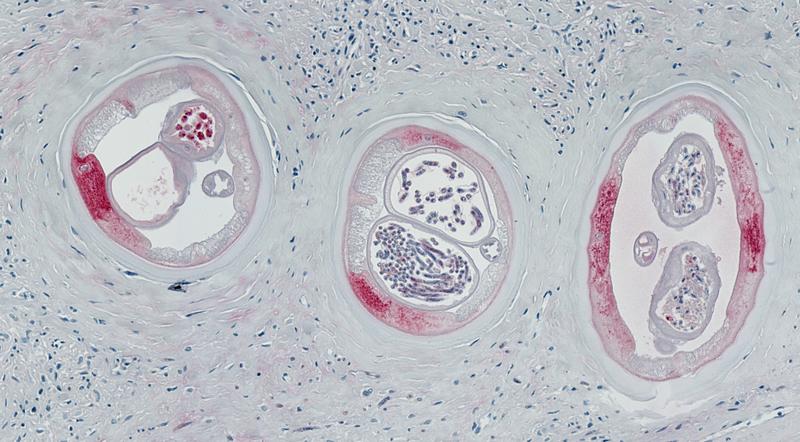 Drei unterschiedliche Anschnitte eines weiblichen Wurms im Knoten nebeneinander: Dunkelrot ist die Färbung des Wolbachia-Oberflächenproteins. Bei den Wolbachien handelt es sich um endosymbiontische Bakterien, die in der Unterhaut und in den Embryonalstad