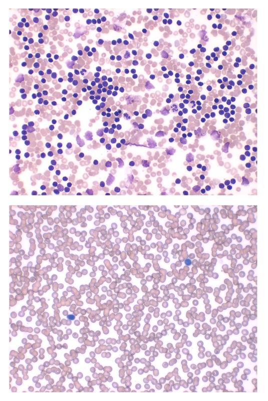Zwei Blutausstriche im Vergleich: (oben) Blut eines Patienten mit CLL. Blau gefärbt die CLL-Zellen. (unten): Gesundes Blut: zu sehen sind überwiegend Erythrozyten (rundlich und rosa-braun). B-Zellen kommen kaum vor. 