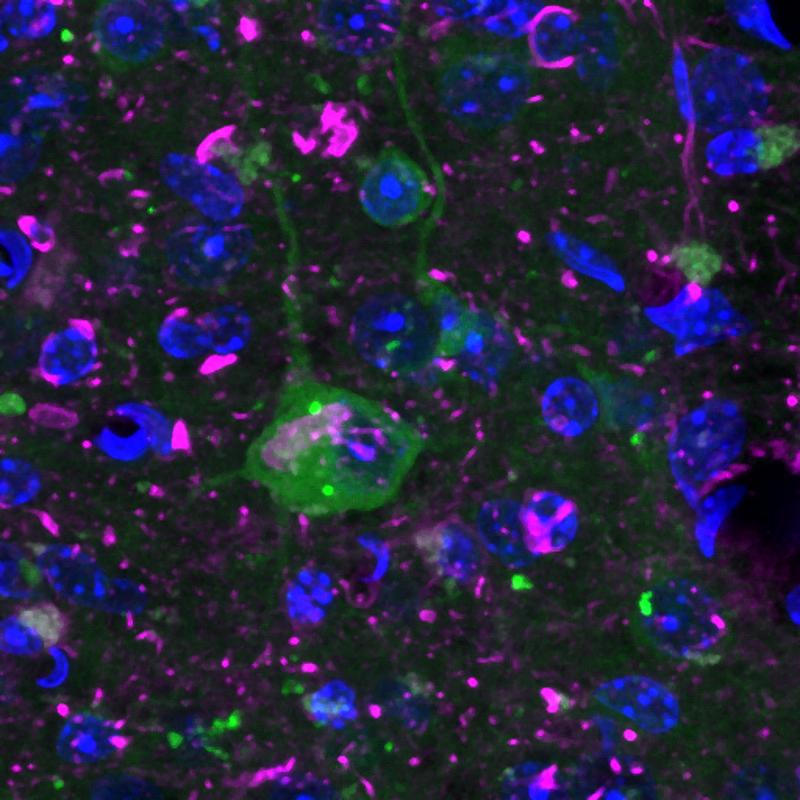 In Zellen, die teilweise die Alzheimer-Krankheit nachbilden, verklumpt der Sensor (Zelle in der Mitte, Punkte in Grün) und weist so auf eine Störung in der Protein-Qualitätskontrolle hin. 