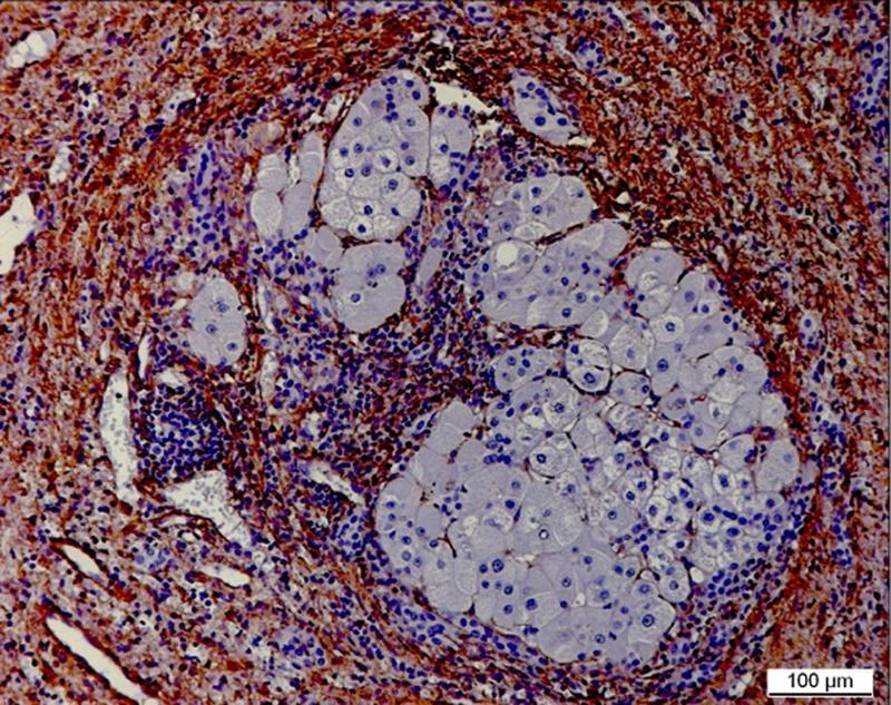 Aktivierte Fibroblasten (braun) und Entzündung (dicht nebeneinanderliegende kleine blaue Kerne) in der Vernarbung eines zirrhotischen Knotens