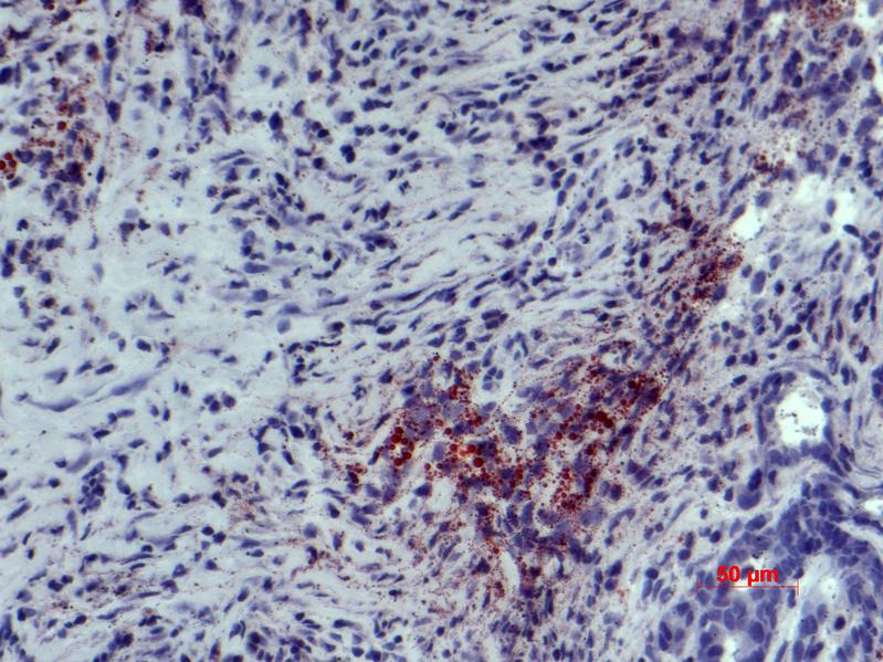 Lichtmikroskopische Aufnahme eines gefärbten Gewebeschnitts eines Darmtumors, Lipide (Triglyceride, Neutralfette) sind leuchtend rot gefärbt, die Zellkerne in Blau (Färbung mit Ölrot-O und Hämatoxylin). 