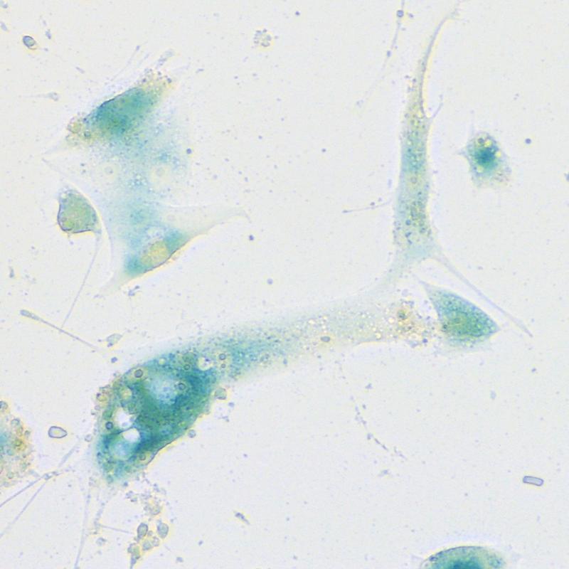 Zellen der menschlichen Nasenschleimhaut, die infolge einer SARS-CoV-2-Infektion das Seneszenzprogramm gestartet haben. Angefärbt wurden sie mit der „Seneszenz-assoziierten Beta-Galaktosidase-Färbung“, einem Standard-Nachweisverfahren für Seneszenz.