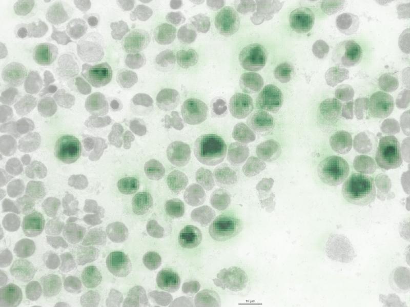 Knochenmarkausstrich eines AML-Patienten. Die neu entwickelte Analysesoftware erkennt eine bestimmte genetische Mutation anhand äußerer Zellmerkmale (dunkelgrüne Färbung).