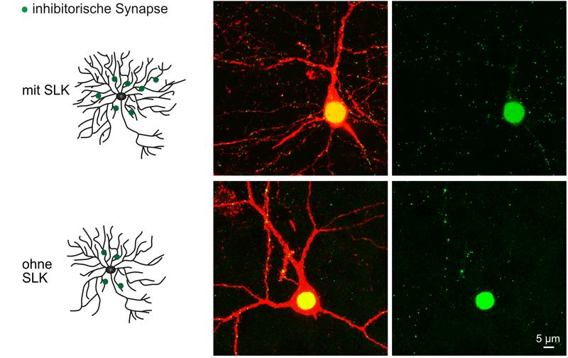 Nervenzellen von Mäusen mit (oben) und ohne SLK (unten). Ohne SLK verzweigen sich die Dendriten weniger stark; außerdem nimmt die Zahl der inhibitorischen Synapsen (grün) ab. 