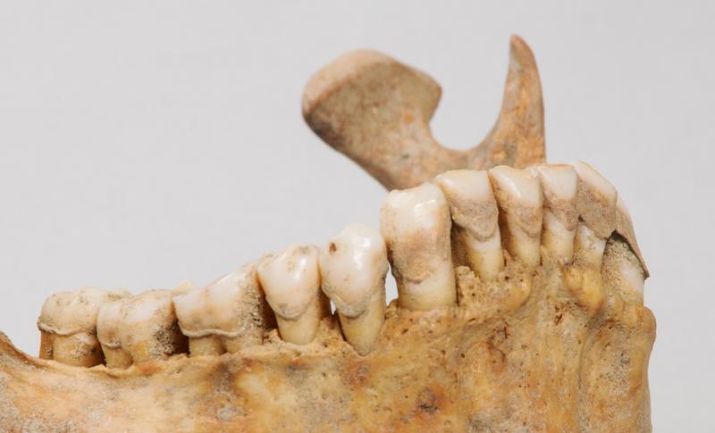 Dental calculus on the mandibular teeth of the early medieval individual