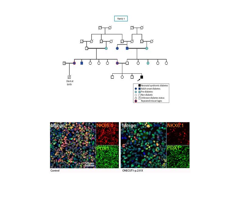 (A) Stammbaum der Indexfamilie, welcher zur Identifikation der ONECUT1-p.231X Mutation führte. 