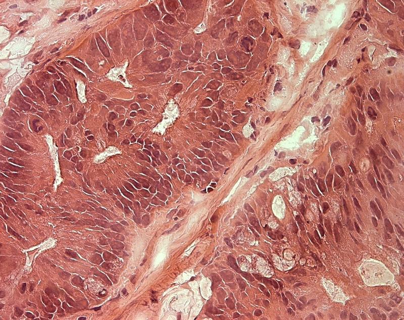 Gezeigt wird ein dünner Schnitt durch einen Tumor aus einem PDX-Modell. Durch die histologische Färbung sind Strukturen der Tumorzellen und der Tumorumgebung (Stroma) erkennbar.