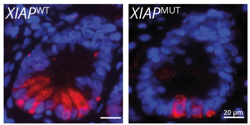 Small intestinal crypts of IBD patients with unchanged (left) and mutated (right) XIAP gene. Paneth cells are labeled in red and nuclei of all cells in a crypt are labeled in blue. The patients with mutated XIAP gene have smaller number of Paneth cells.