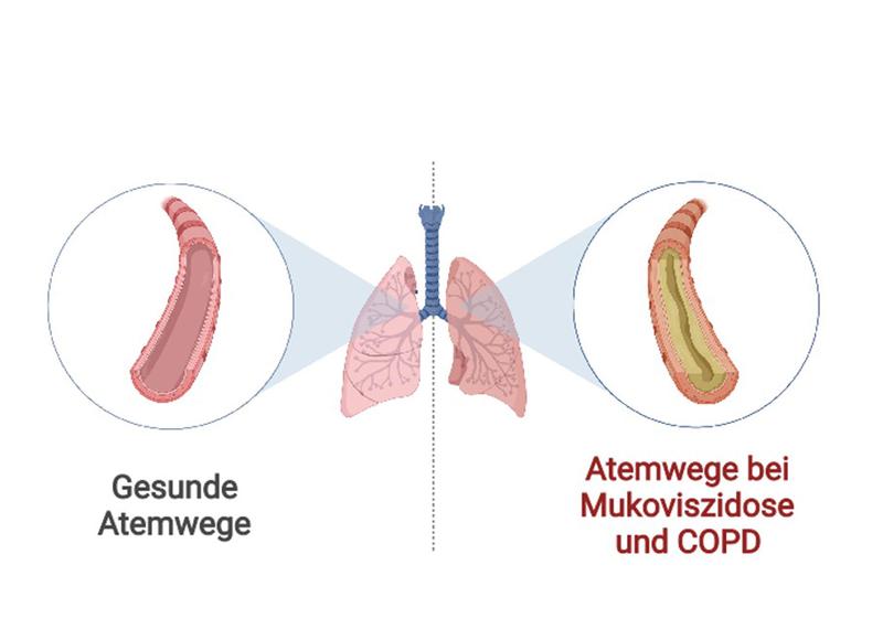 Die Atemwege von Patienten mit Mukoviszidose und COPD sind mit zähem Schleim verstopft. Forschende des Deutschen Zentrums für Lungenforschung fanden heraus, dass die Verschleimung zu einer chronischen Entzündung der Atemwege beiträgt.