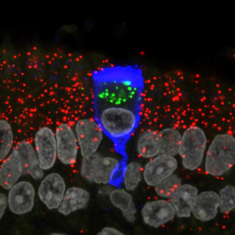 A lone infected sustentacular cell is surrounded by non-infected cells in the olfactory mucosa of a COVID-19 patient who died four days after diagnosis of the infection. The infected cell has the characteristic shape of a wine glass. 