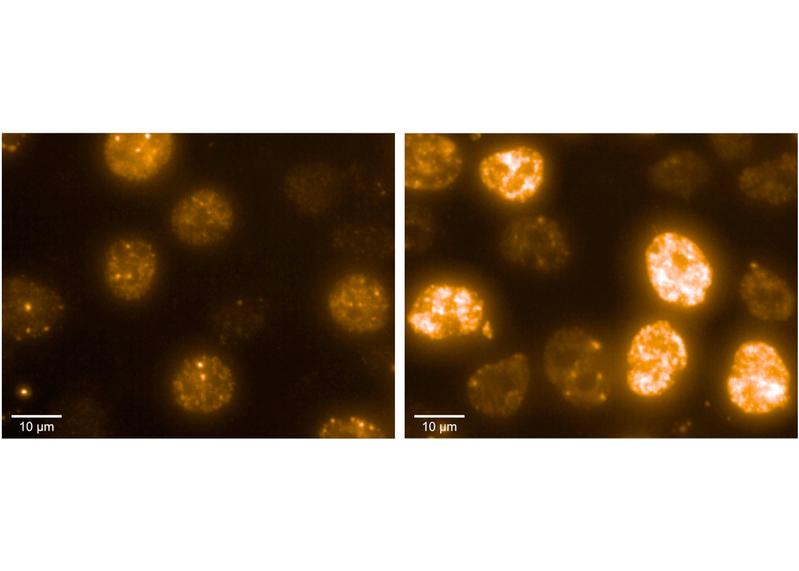 Neuroblastomzellen unter dem Mikroskop. Die Färbung stellt DNA-Schäden dar, je intensiver, desto stärker und gefährlicher der Schaden. Zellen auf der rechten Seite haben kein RNA-Exosom und sind daher wesentlich anfälliger für solche Schäden