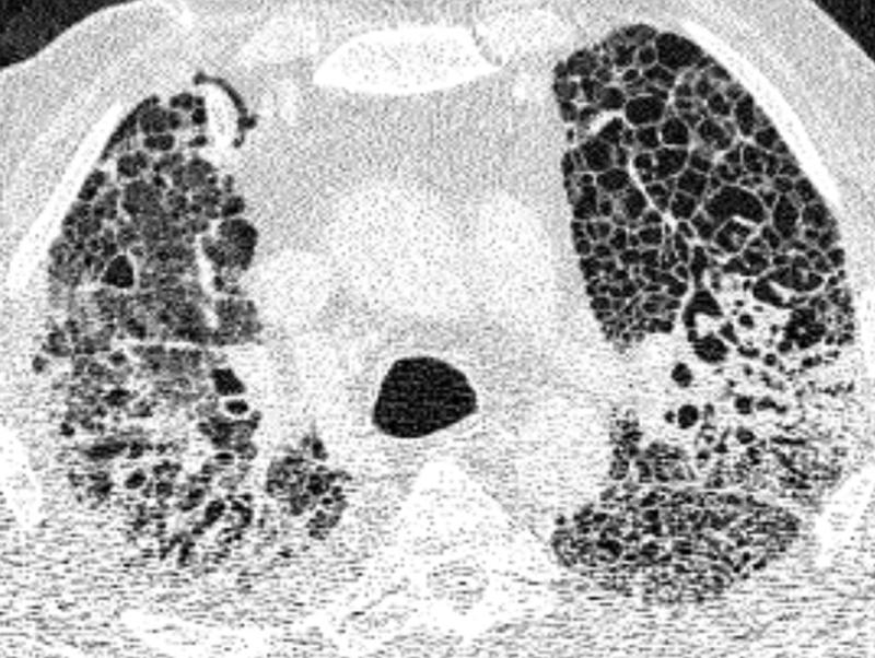 Computertomographie-Aufnahme (CT-Bild) der Lunge eines Patienten mit COVID-19-Lungenversagen. Helle Bereiche zeigen Verdichtungen und Vernarbungen des Lungengewebes.