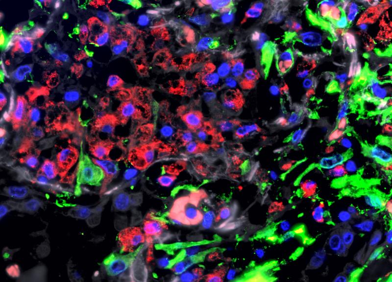 Immunfluoreszenz-Aufnahme der Lunge eines Patienten mit schwerem COVID-19: In dem stark geschädigten Lungengewebe sammeln sich Fresszellen (Makrophagen, rot) an. Grün angefärbt sind Bindegewebszellen (Fibroblasten). 