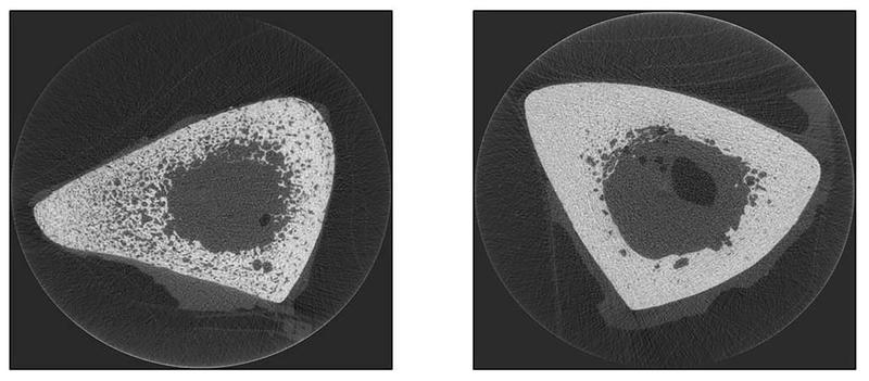 Mit zunehmendem Alter nimmt die Knochendichte ab, der Knochen wird porös, das Risiko für einen Knochenbruch steigt. Links ein Querschnitt durch ein osteoporotisches Schienbein (30% Porosität), rechts im Vergleich dazu ein gesunder Knochen (5% Porosität)