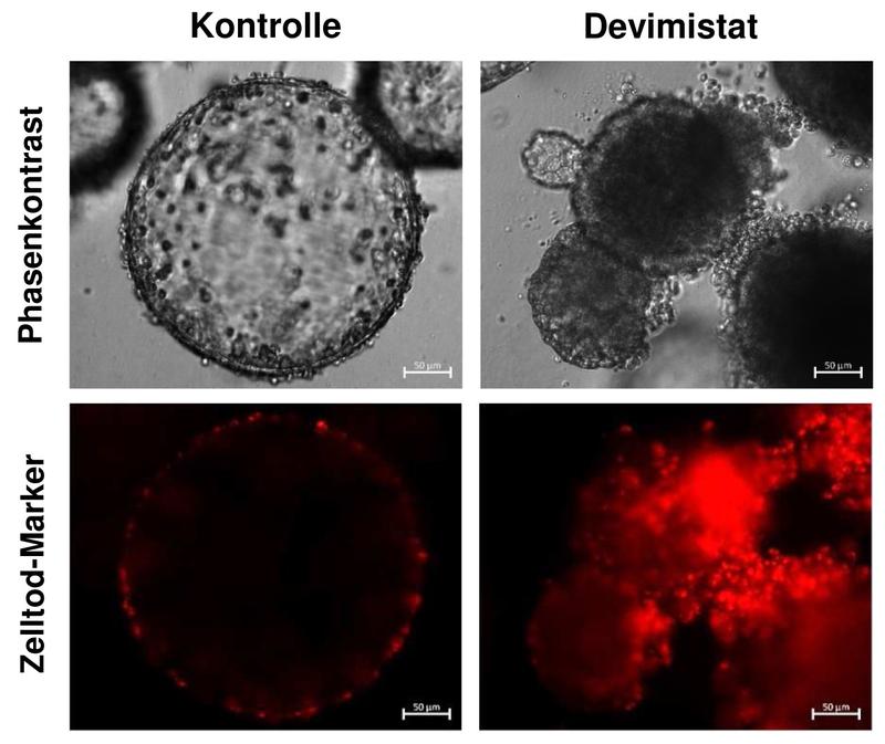 Darmtumor-Organoide nach Behandlung mit Devimistat (rechts) sowie ohne Behandlung (links). Dargestellt sind die Tumororganoide im Phasenkontrast und nach Färbung mit einem roten Zelltodmarker.