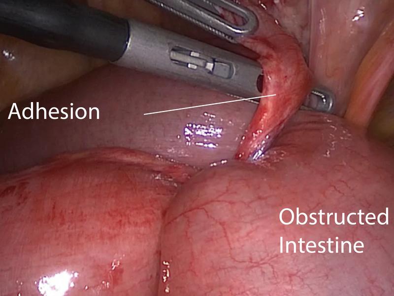 Verwachsungen (Adhesion) nach Operation im Bauchbereich: Hier eine Adhäsion mit einer partiellen Einschnürung des Dünndarms (Obstructed small intestine).  