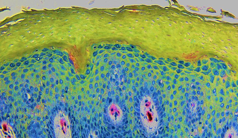 Querschnitt durch die Haut eines Neurodermitis-Patienten: Zellkerne der Hautzellen (blau), äußerste Hautschicht (grün), die bei Neurodermitis eine charakteristische Verdickung aufweist. Der Schnitt wurde mit Hämatoxylin gefärbt, Farben wurden verändert.