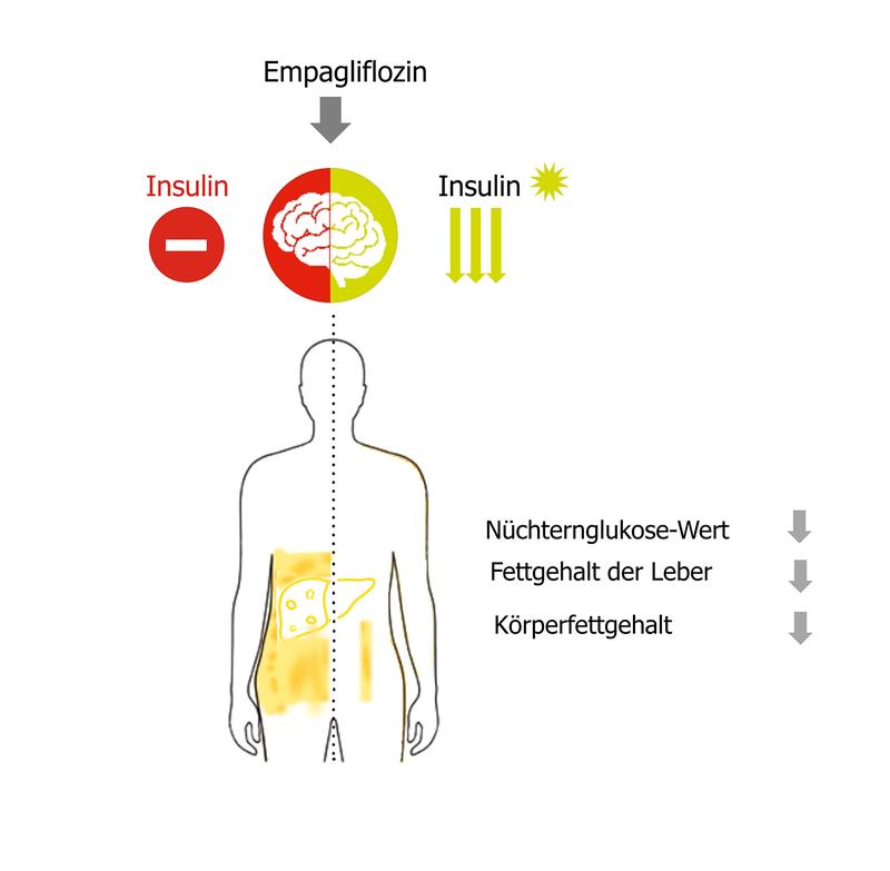 Das Diabetes-Medikament Empagliflozin normalisiert die Insulinwirkung im Gehirn, verbessert die Nüchternglukose-Werte, senkt den Fettgehalt der Leber und reduziert den Körperfettgehalt.