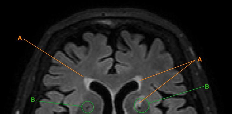 Ausschnitt eines mittels MRT gemessenen Gehirns im Horizontalschnitt mit Hyperintensitäten der weissen Substanz (A) und Lakunen (B)