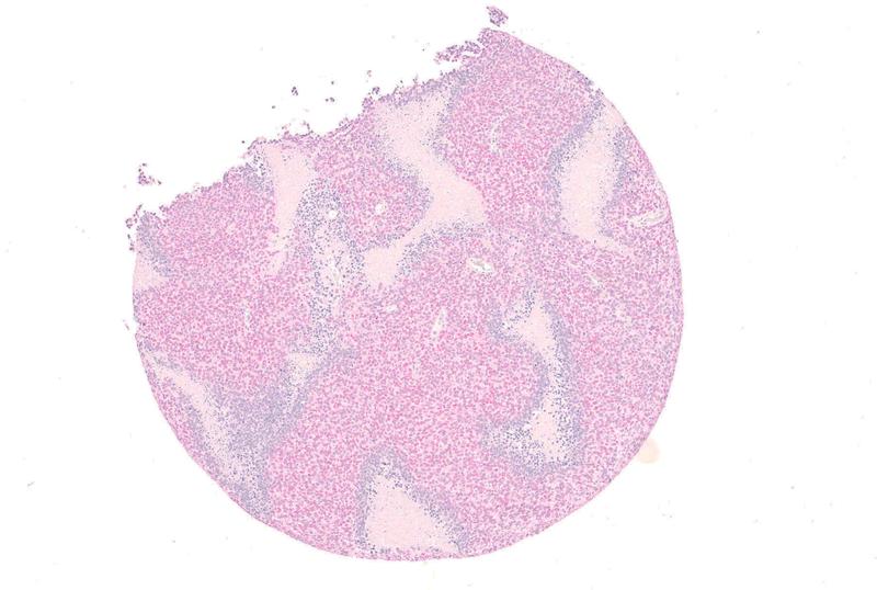 Gewebeschnitt durch ein Ewing-Sarkom: Wird die EWSR1-FLI1-Produktion gedrosselt, steigt die Menge des Biomarkers TCF7L1 in den Krebszellen (pink).