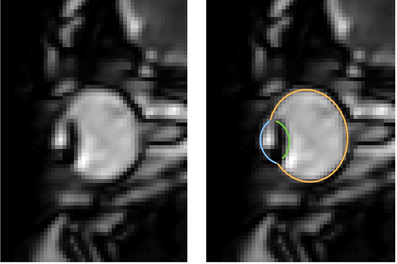MRI images of eye movements during blinking: The eye is pulled back into the eye socket. The left image shows only the dynamic MRI data, the right image additionally shows the segmentation of the eye by the MREyeTrack. 
