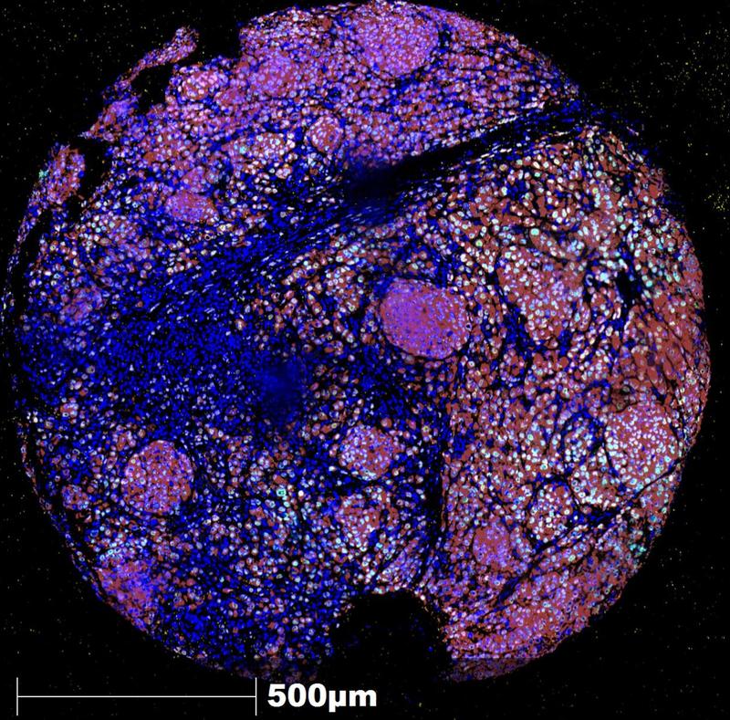 Gewebeprobe eines Melanoms in starker Vergrößerung - unterschiedlich angefärbt sind dabei Erkennungsmerkmale von Melanomzellen. Das bunte Erscheinungsbild verdeutlicht die Wandlungsfähigkeit der Melanomzellen.