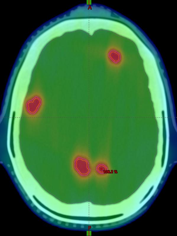 Einzelne Metastasen sind als durchgezogene Linien markiert und die geplante Dosisverabreichung farbkodiert dargestellt.