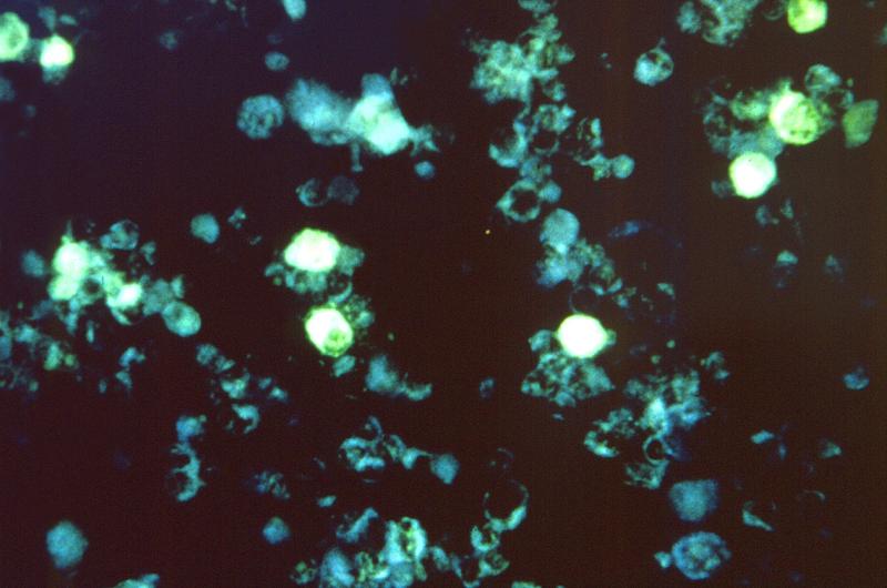 Mit Hilfe von fluoreszierenden Antikörpern zeigt diese mikroskopische Aufnahme die kumulative Wirkung des Epstein-Barr-Virus auf Zellen unbekannter Herkunft.