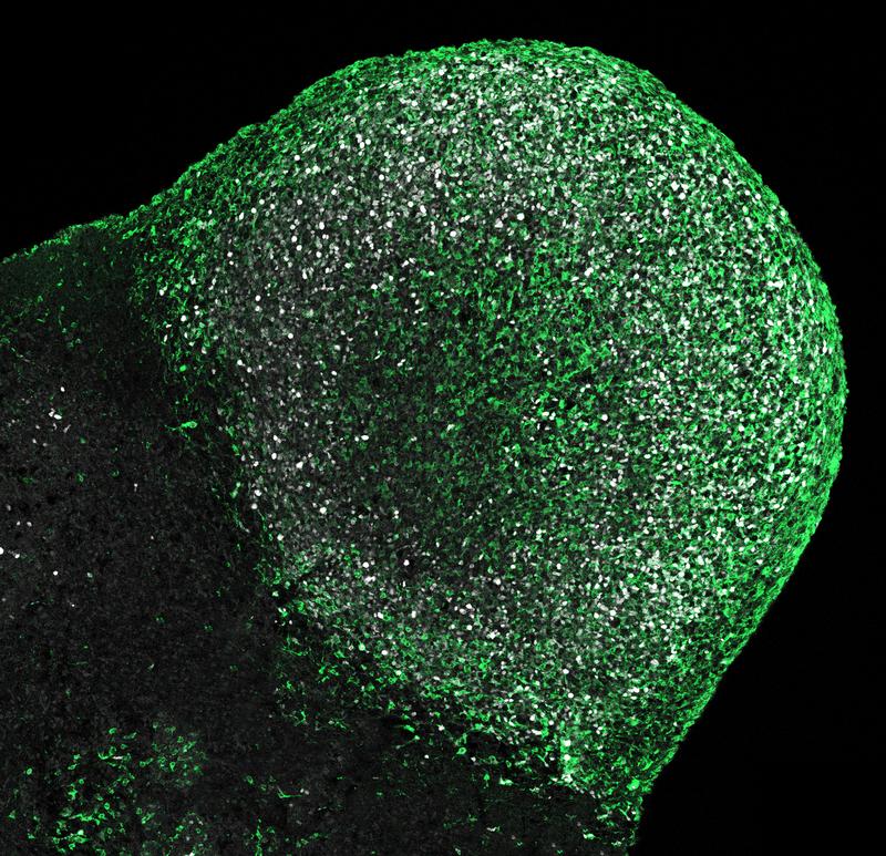 Tumor on a Tuberous Sclerosis (TSC) patient-derived brain organoid