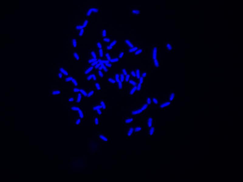 Angefärbte und durch Fluoreszenzmikroskopie sichtbar gemachte Chromosomen einer Krebszelle