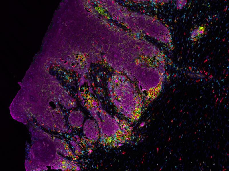 Mehrfarbige Immunfluoreszenz von Tumor und Immunzellen im HNO Tumormirkoklima 