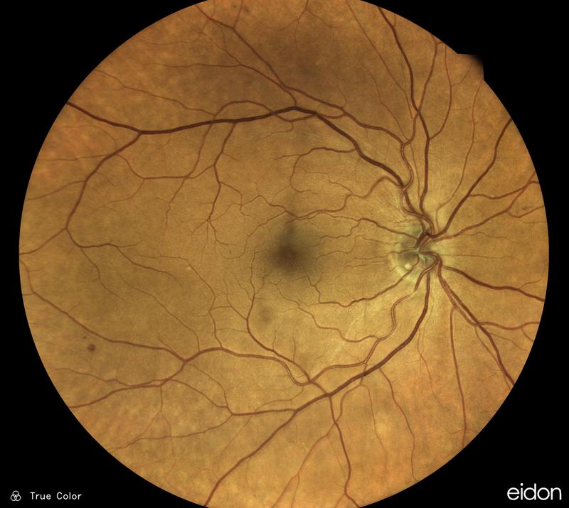 Der Augenhintergrund des Menschen ist gut durchblutet. Wenn man die Gefäße durch die Augenlinse fotografiert, können neuronale Netze anhand der Aufnahmen bestimmte Krankheiten erkennen.