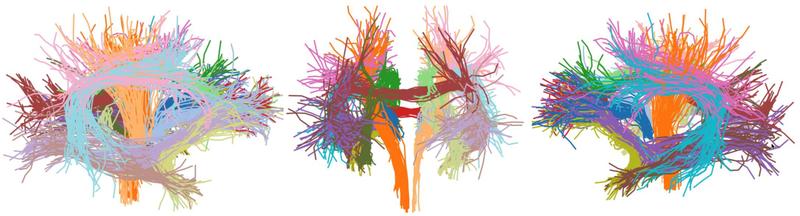 Das Gehirn von Neugeborenen enthält eine Vielzahl von Nervenbahnen, die ein Team aus der Neurowissenschaft mit Magnetresonanztomografie untersucht hat. 