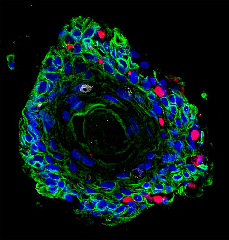 Ektozervikale, geschichtete Plattenepithel-Organoide, die von Patientinnen stammen (grün). Rote Bereiche markieren eine Infektion mit Chlamydia trachomatis.