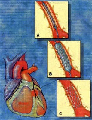 Implantation eines Stents: Die Gefäßstütze wird mit einem Ballonkatheter an die Engstelle des Blutgefäßes gebracht (A). Nach der Aufdehnung des Engpasses (B) bleibt der Stent als Stütze im Gefäß (C).