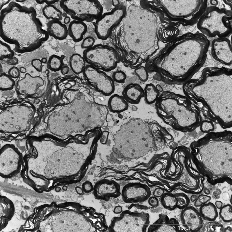 In mice injected with casein, the structure of myelin loosens. It only loosely covers the axons. Sometimes the insulating layer is even missing altogether.