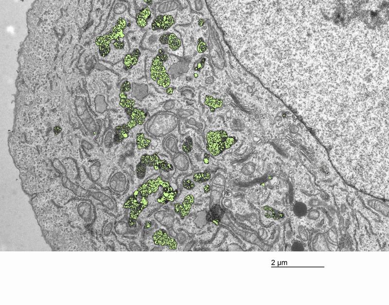 Im Zellinnern: Nanopartikel aus Hafniumdioxid (eingefärbt) sammeln sich in den Krebszellen an und können nach Bestrahlung Zellschaden anrichten. (Elektronenmikroskopie, nachkoloriert) 