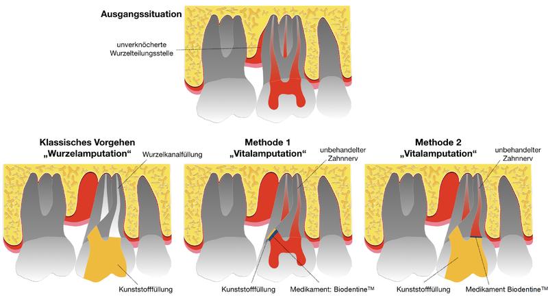 Schematisch Darstellung des klassischen Verfahrens (Wurzelamputation, links) sowie beider im Rahmen der Studie untersuchten Therapieverfahren (Vitalamputation unter Belassen der Kronenpulpa, mittig, bzw. mit Entfernung der Kronenpulpa, rechts).