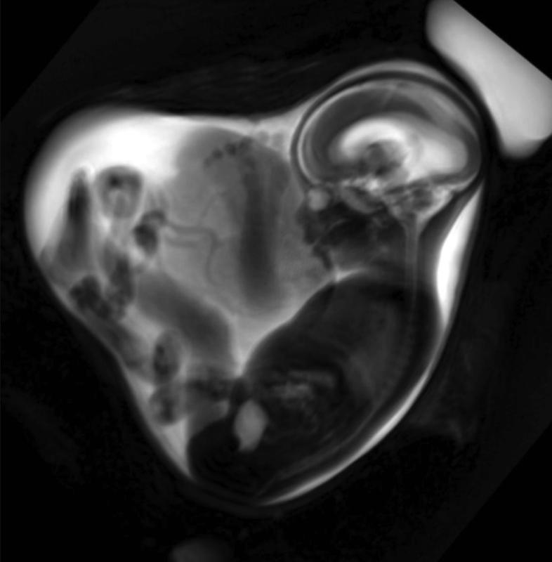 Die fetale MRT ist eine spezialisierte Bildgebungsmethode der pränatalen Diagnostik, die etwa ab der 18. Schwangerschaftswoche eingesetzt werden kann.