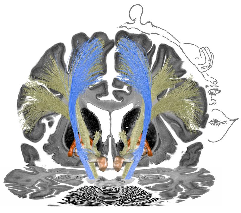 Die Stimulation der blauen Trakte ging mit einer Verbesserung der Symptomatik bei Patienten mit zervikaler Dystonie einher, die Stimulation der gelbfarbenen Trakte bei der Patientengruppe mit generalisierter Dystonie. Im Hintergrund sind S