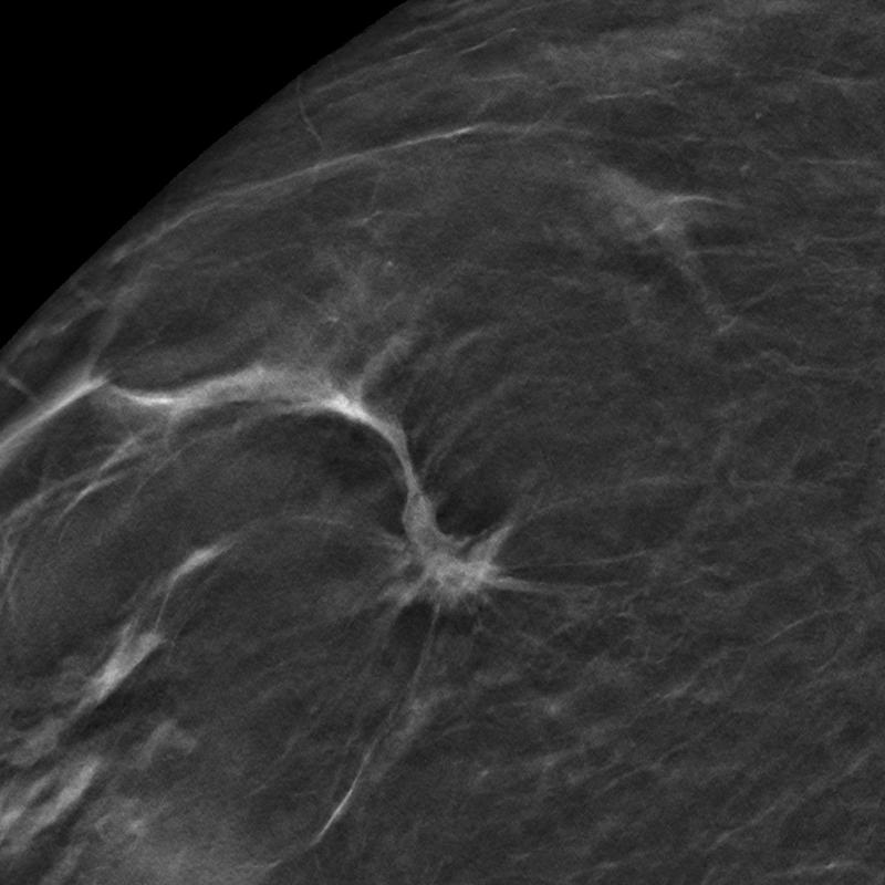 Einzelschicht einer digitalen Brust-Tomosynthese mit Strukturstörung als mammographisches Zeichen eines invasiv lobulären Mammakarzinoms