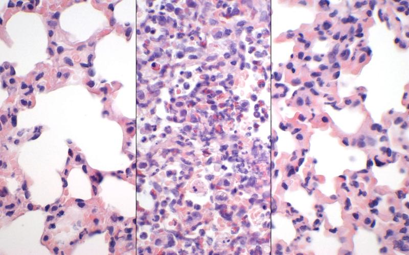 In jeweils 600-facher Vergrößerung: gesundes Lungengewebe mit offenen Lungenbläschen (links), schwere SARS-CoV-2-Infektion mit zerstörtem Gewebe und Immunzellen (mitte), deutlich weniger Zerstörung nach Kombinationsbehandlung (rechts))