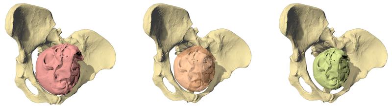 Geburtssimulation von Lucy (Australopithecus afarensis) mit drei unterschiedlich grossen Fetuskopfgrössen. Nur eine Gehirngrösse von maximal 30 Prozent der Erwachsenengrösse (rechts) passt durch den Geburtskanal. 