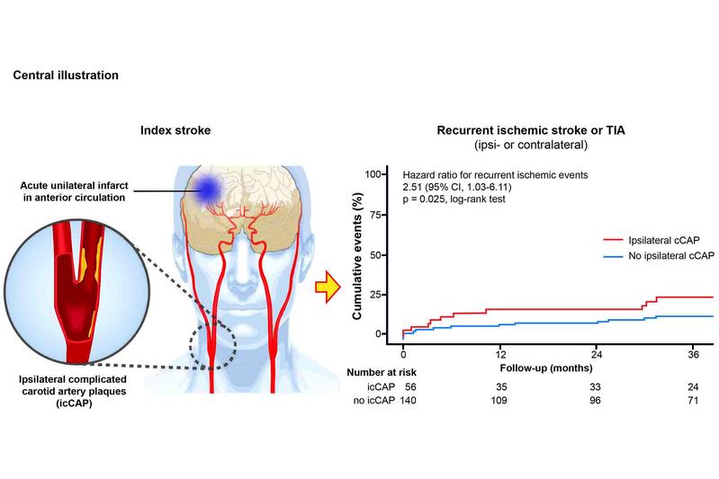 Komplizierte Plaques in der Halsschlagader als Risikofaktor für einen erneuten Schlaganfall