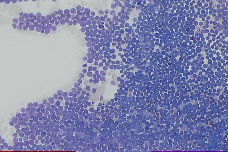 Bei der Akut Myeloischen Leukämie (AML) vermehrt sich ein Vorläufertyp der weißen Blutkörperchen (Myeloblasten, dunkel eingefärbt) übermäßig und verdrängt andere Blutzell-Typen. Durch die neuartige Therapie wird diese Zell-Vermehrung gestoppt.