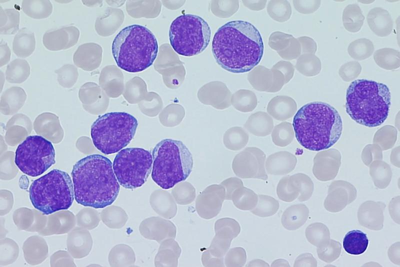 Krebszellen im Detail: Myeloblasten zeichnen sich durch ihren sehr großen, rund-ovale Zellkern aus. Transparent: rote Blutkörperchen.