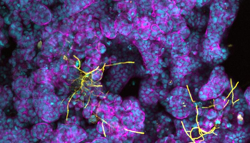 Candida albicans (gelb) bildet Hyphen auf differenzierten Darmepithelzellen (Zellkern in blau und F-Actin in lila).